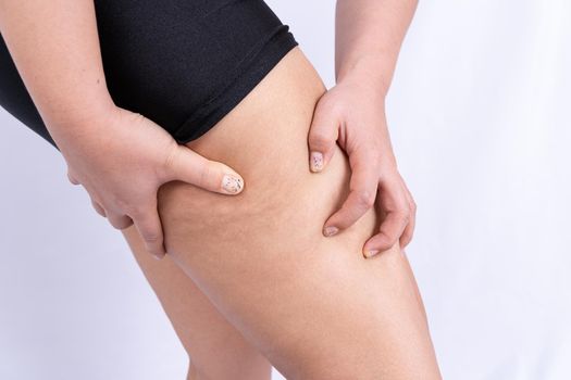 Female holding and pushing the skin of the legs cellulite, orange peel. Treatment and disposal of excess weight, the deposition of subcutaneous fat tissue
