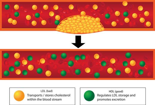 Role of good and bad lipids and levels of atherosclerotic plaque in blood vessel medical vector infographics