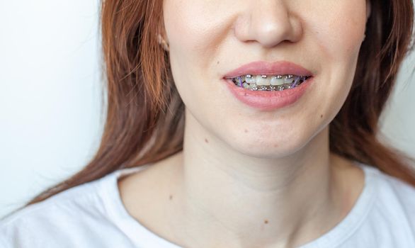 Braces in the smiling mouth of a girl. Close-up photos of teeth and lips. Smooth teeth from braces. On the teeth of elastic bands for tightening teeth. Photo on a light solid background.