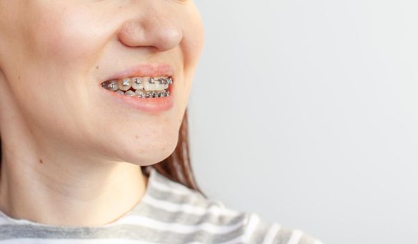 Braces in the smiling mouth of a girl. Close-up photos of teeth and lips. Smooth teeth from braces. On the teeth of elastic bands for tightening teeth. Photo on a light solid background.