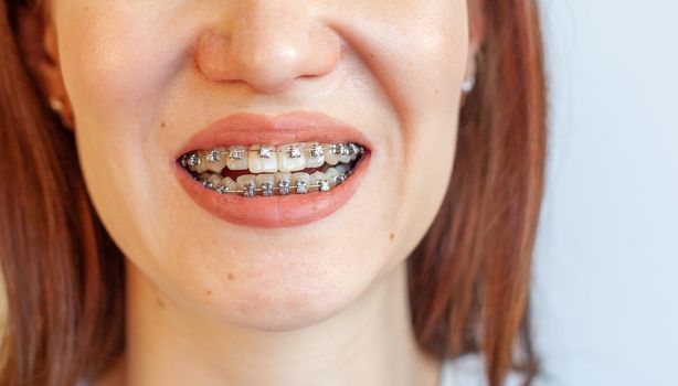 Braces in the smiling mouth of a girl. Close-up photos of teeth and lips. Smooth teeth from braces. On the teeth of elastic bands for tightening teeth. Photo on a light solid background.