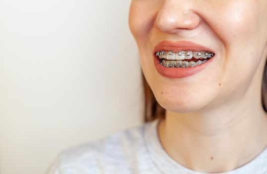 Braces in the smiling mouth of a girl. Close-up photos of teeth and lips. Smooth teeth from braces. On the teeth of elastic bands for tightening teeth. Photo on a light solid background.