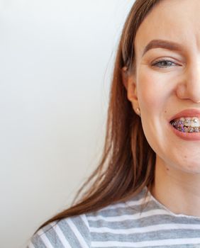 Braces in the smiling mouth of a girl. Close-up photos of teeth and lips. Smooth teeth from braces. On the teeth of elastic bands for tightening teeth. Photo on a light solid background.