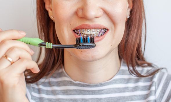 Braces in the smiling mouth of a girl. Close-up photos of teeth and lips. Smooth teeth from braces. On the teeth of elastic bands for tightening teeth. Photo on a light solid background.