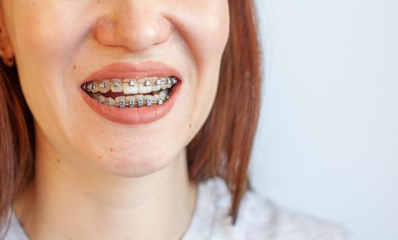 Braces in the smiling mouth of a girl. Close-up photos of teeth and lips. Smooth teeth from braces. On the teeth of elastic bands for tightening teeth. Photo on a light solid background.