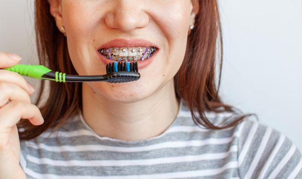 Braces in the smiling mouth of a girl. Close-up photos of teeth and lips. Smooth teeth from braces. On the teeth of elastic bands for tightening teeth. Photo on a light solid background.