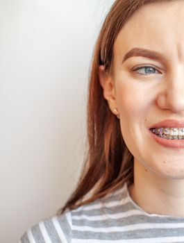 Braces in the smiling mouth of a girl. Close-up photos of teeth and lips. Smooth teeth from braces. On the teeth of elastic bands for tightening teeth. Photo on a light solid background.