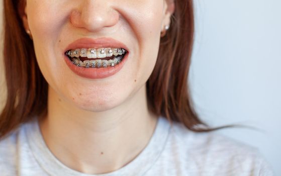 Braces in the smiling mouth of a girl. Close-up photos of teeth and lips. Smooth teeth from braces. On the teeth of elastic bands for tightening teeth. Photo on a light solid background.