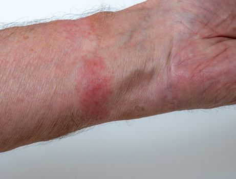 Close up of contact dermatitis or skin allergy due to wearing a leather watch strap