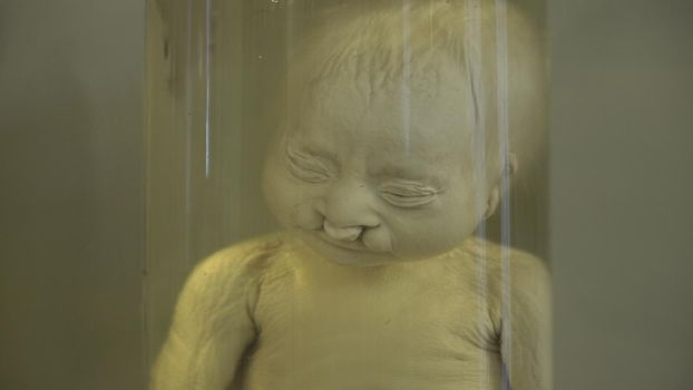 Anatomical preserved human specimens, ugliness, anomalies. Human parts of the body preserved in formalin for scientific study by scientists. Exhibition items in autopsy room.