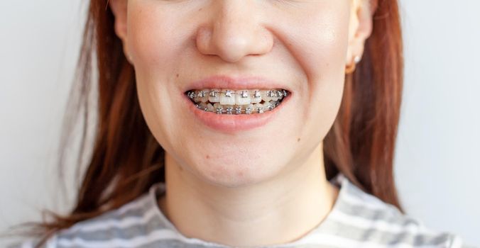 Braces in the smiling mouth of a girl. Close-up photos of teeth and lips. Smooth teeth from braces. On the teeth of elastic bands for tightening teeth. Photo on a light solid background.