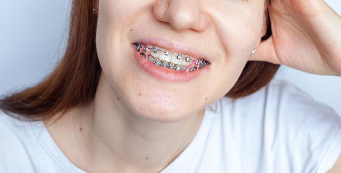 Braces in the smiling mouth of a girl. Close-up photos of teeth and lips. Smooth teeth from braces. On the teeth of elastic bands for tightening teeth. Photo on a light solid background.