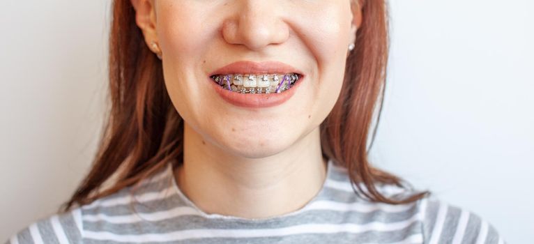 Braces in the smiling mouth of a girl. Close-up photos of teeth and lips. Smooth teeth from braces. On the teeth of elastic bands for tightening teeth. Photo on a light solid background.