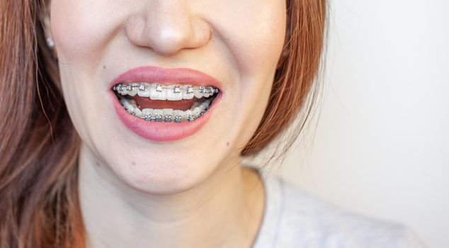 Braces in the smiling mouth of a girl. Close-up photos of teeth and lips. Smooth teeth from braces. On the teeth of elastic bands for tightening teeth. Photo on a light solid background.