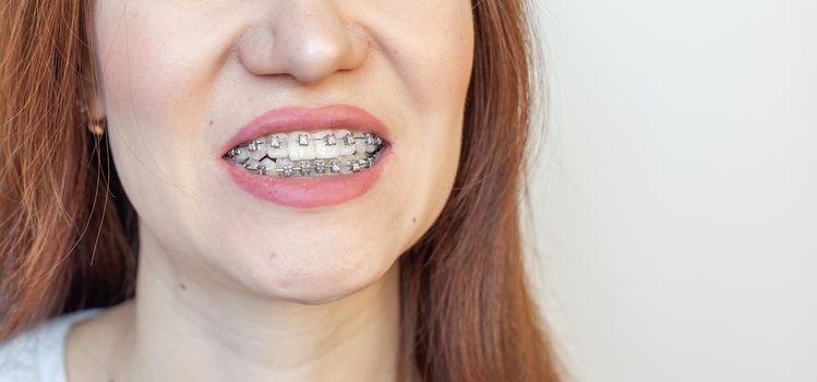 Braces in the smiling mouth of a girl. Close-up photos of teeth and lips. Smooth teeth from braces. On the teeth of elastic bands for tightening teeth. Photo on a light solid background.