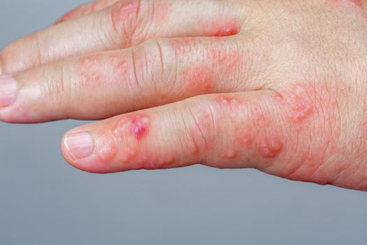 Shingles, Zoster or Herpes Zoster symptoms on arm