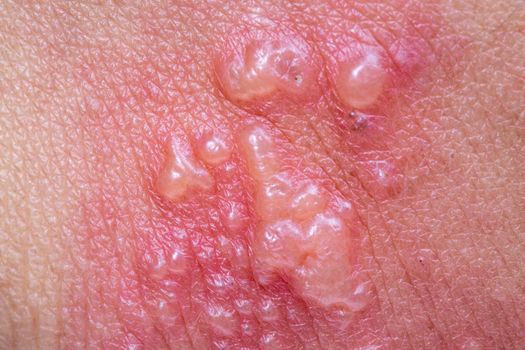 Shingles, Zoster or Herpes Zoster symptoms on arm