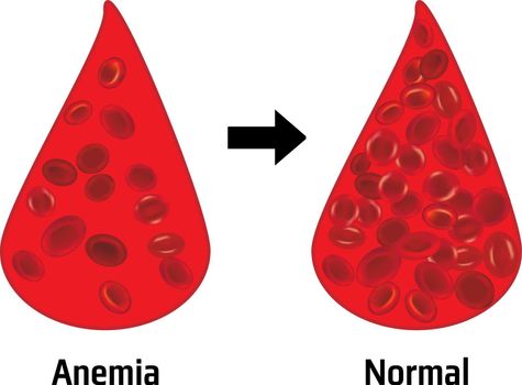 Anemia and normal amount of red blood cells in a drop of blood vector illustration