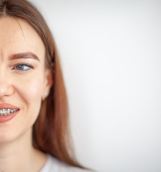 The smile of a young girl with braces on her white teeth. Teeth straightening. Malocclusion. Dental care. 