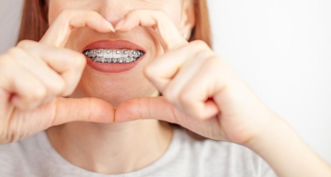 A beautiful woman with braces on her white teeth through a frame from her hands. Straightening and dental hygiene. Dental care.