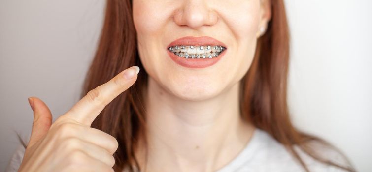 The girl points her finger at the even and white teeth with braces. Straightening your teeth with braces. Dental care.