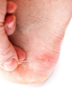 Blister on heel gets pricked with sewing needle to burst it on white background, close-up with selective focus.