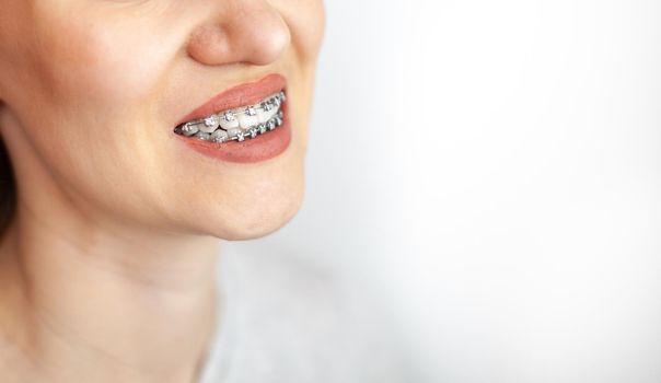 The smile of a young girl with braces on her white teeth. Teeth straightening. Malocclusion. Dental care. 