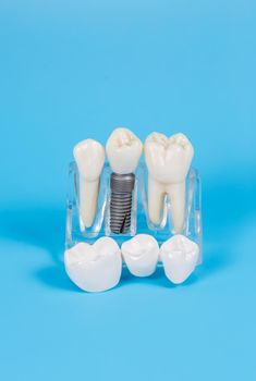 Plastic dental crowns, imitation of a dental prosthesis of a dental bridge for three teeth with a metal screw implant on a blue background.