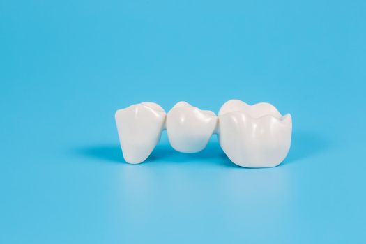 Plastic dental crowns, imitation of a dental prosthesis of a dental bridge for three teeth on a blue background.Visual aid for dentists and patients.