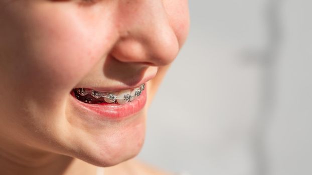 Close up of a teenage girl smiling in orthodontic brackets. Girl with braces on teeth. Orthodontic Treatment.