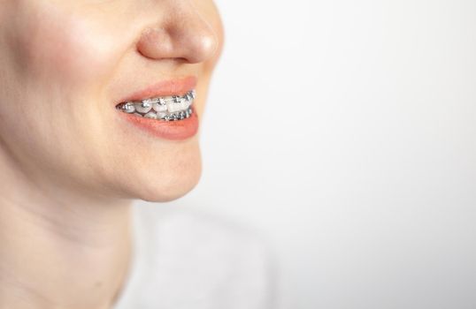 The smile of a young girl with braces on her white teeth. Teeth straightening. Malocclusion. Dental care. 