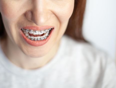 The smile of a young girl with braces on her white teeth. Teeth straightening. Malocclusion. Dental care. 