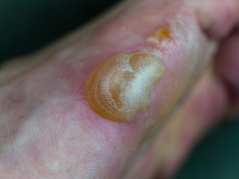 Big blister and flaking skin on foot from Pompholyx eczema