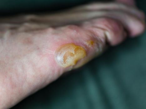 Big blister and flaking skin on foot from Pompholyx eczema