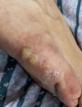 Multiple blisters and flaking skin on foot