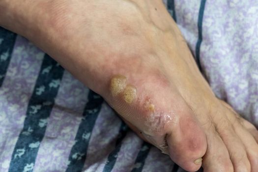 Multiple blisters and flaking skin on foot