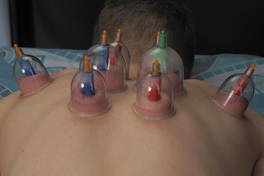 A can of back massage. The patient on the couch with vacuum cans on his back. High quality photo