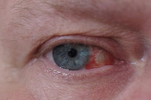 A man's eye. It's a macro- Eye disease, hemorrhage in the eye. High quality photo