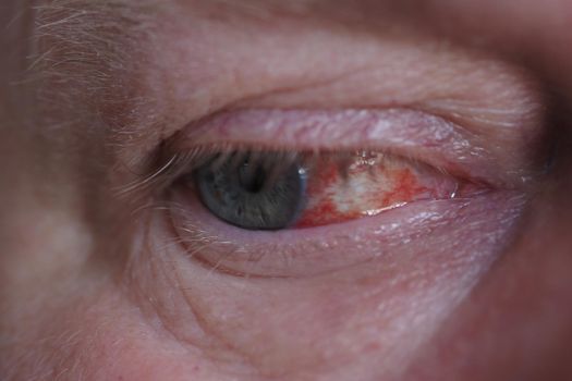 A man's eye. It's a macro- Eye disease, hemorrhage in the eye. High quality photo