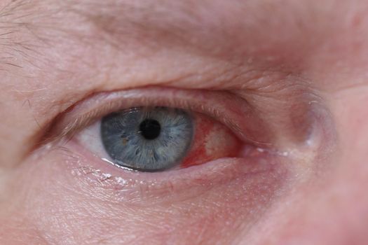 The eye of a man, a macro- star. hemorrhage. Sick eye, blood vessel burst. High quality photo