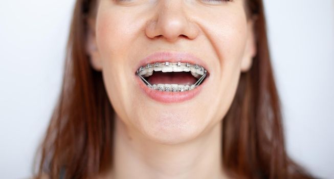 The woman smiles, showing her white teeth with braces. Even teeth from wearing braces. The concept of a dentist and an orthodontist.