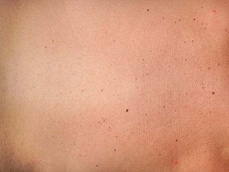 Detail of back skin with some pigment spots or birthday mark - young woman sunbathing.