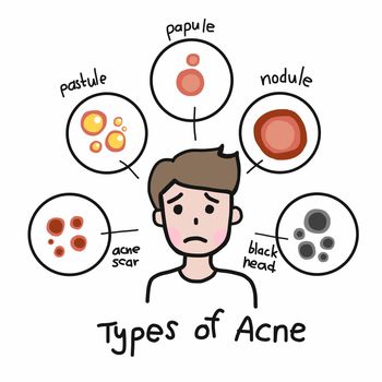 Type of acne , Cute man cartoon face vector illustration