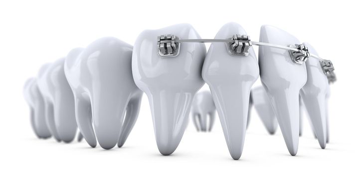 Metal dental brackets mounted on the teeth. 3d render.