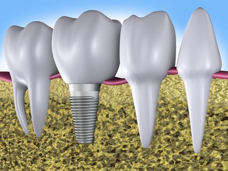 a teeth  and dental implants, 3d render