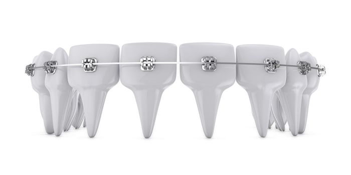metal dental brackets mounted on the teeth