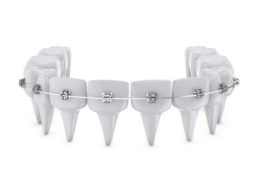 metal dental brackets mounted on the teeth