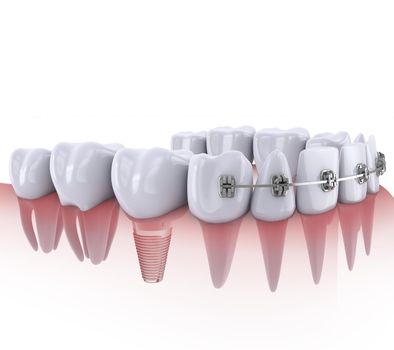 a teeth with braces and dental implants