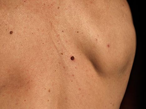 Growing red mole on man's back. Skin cancer symptom.