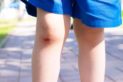 The wound on the child's leg . Fell on the road. Broken knee. Health. Article about the fall of a child. Article about the treatment of wounds. Bad leg . The child fell and broke his knee . blood